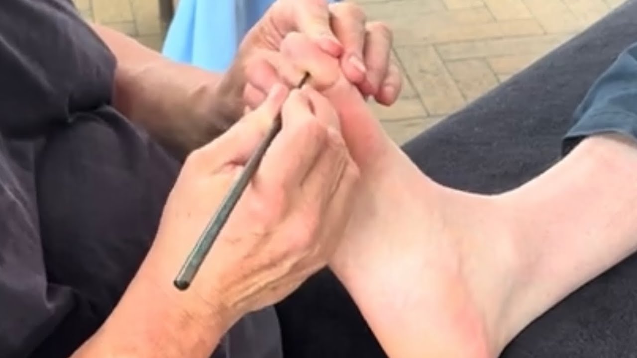 Intense Foot Massage Using Tools for Plantar Fasciitis | Raynor Reflexology Deep Tissue Therapy